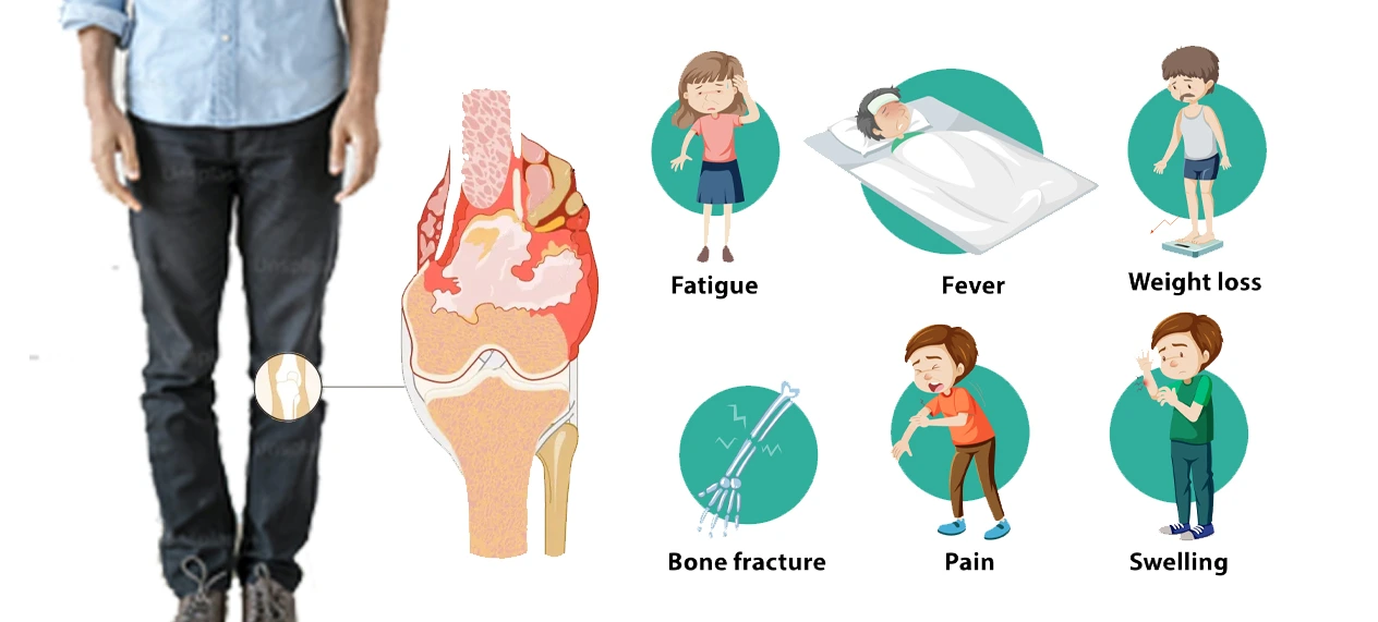 Understanding Pediatric Bone Cancer: Symptoms, Treatment, And Care